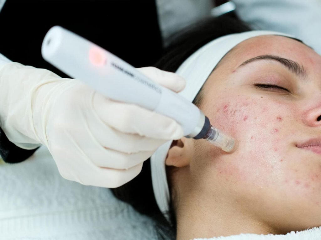 Acne treatment on a client's cheek