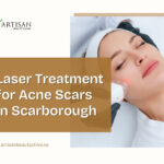 Laser treatment being performed on facial skin to reduce acne scars at a professional clinic