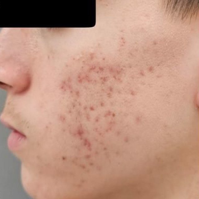 After Acne Treatment