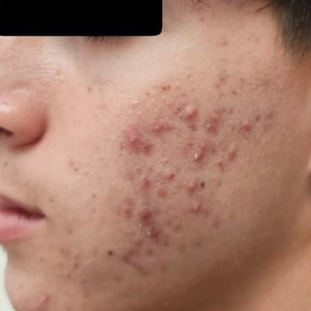 Before Acne Treatment
