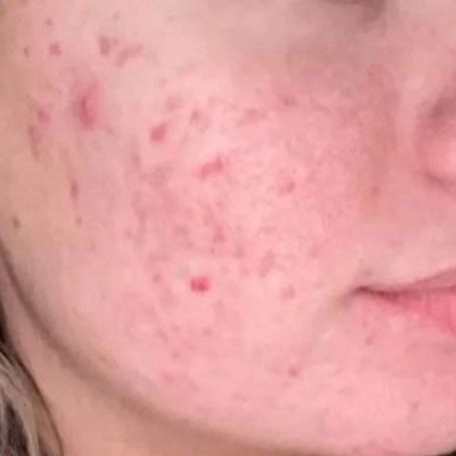 After Skin Resurfacing