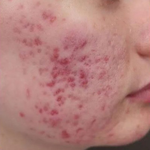 Before Skin Resurfacing