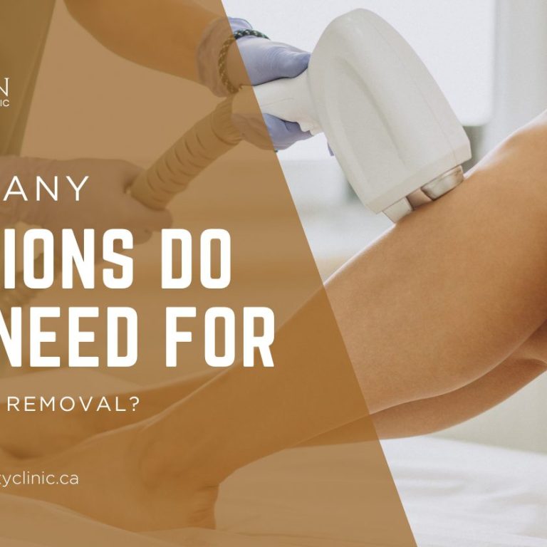 How Many Sessions Do You Need For Laser Hair Removal