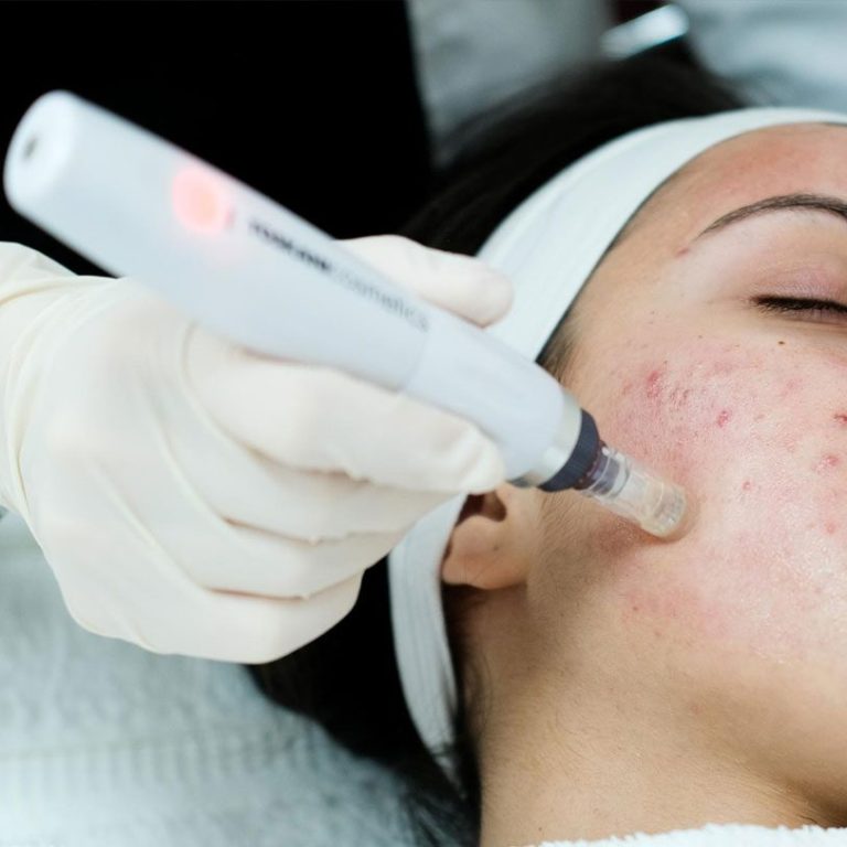 Acne-Removal-Treatment