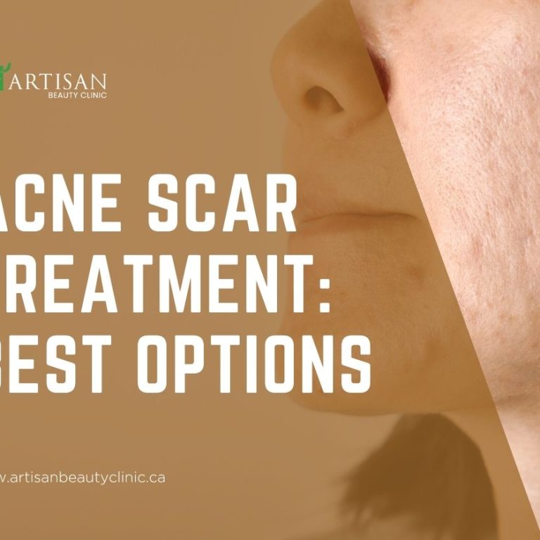 Acne Scar Treatment